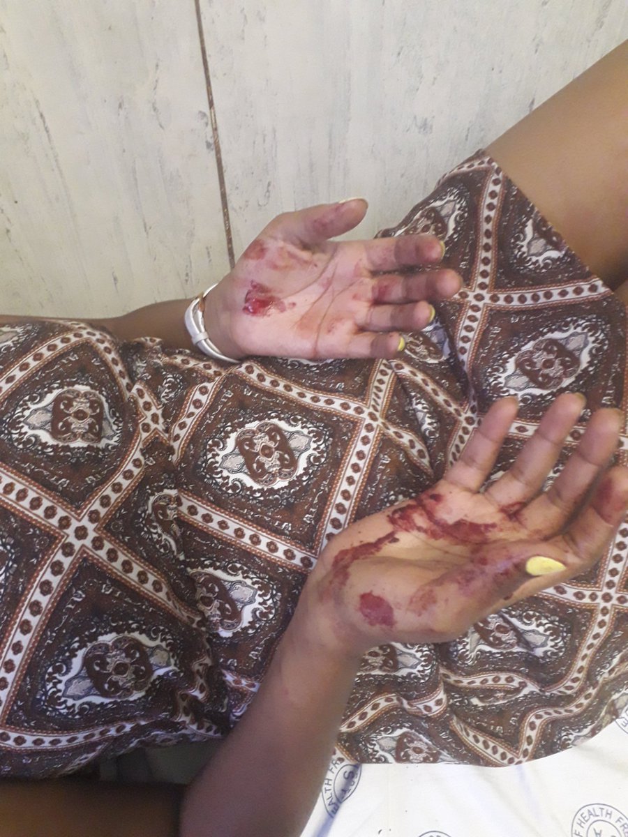 Rethabzz's tweet photo. @GenBheki_Cele This is my friend lying in a hospital bed because we hooted at a white male driving a @ChemcoSa car at @KFCSA Willows drive-thru in Bloemfontein this morning. He hit her with a fist &amp; broke her front teeth.I tried to stop him and then he turned his attention to me. https://t.co/f70ongLdRp