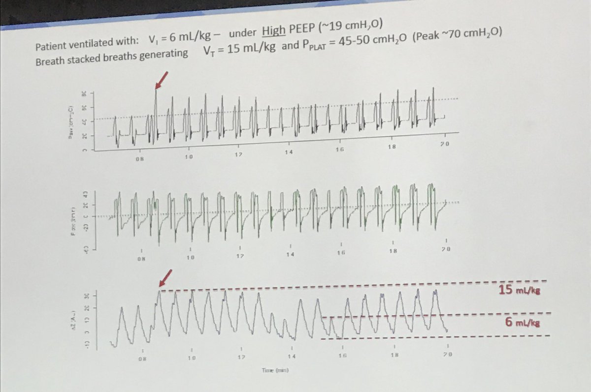 FilipeAmado1's tweet photo. Prof. Marcelo Amato, #ART Investigator, emphasizes 5 weakness about the #ART protocol. The use of VCV during the assisted phase increased double-triggering.#CBMI2018 #AMIB @AMIB_oficial https://t.co/0EmiutlhZy