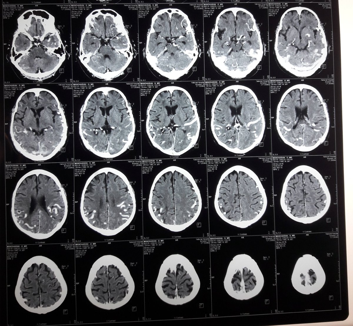 This is contrast CT Brain
Whats the radiological diagnosis ? #radiology#neurology#neuroquiz