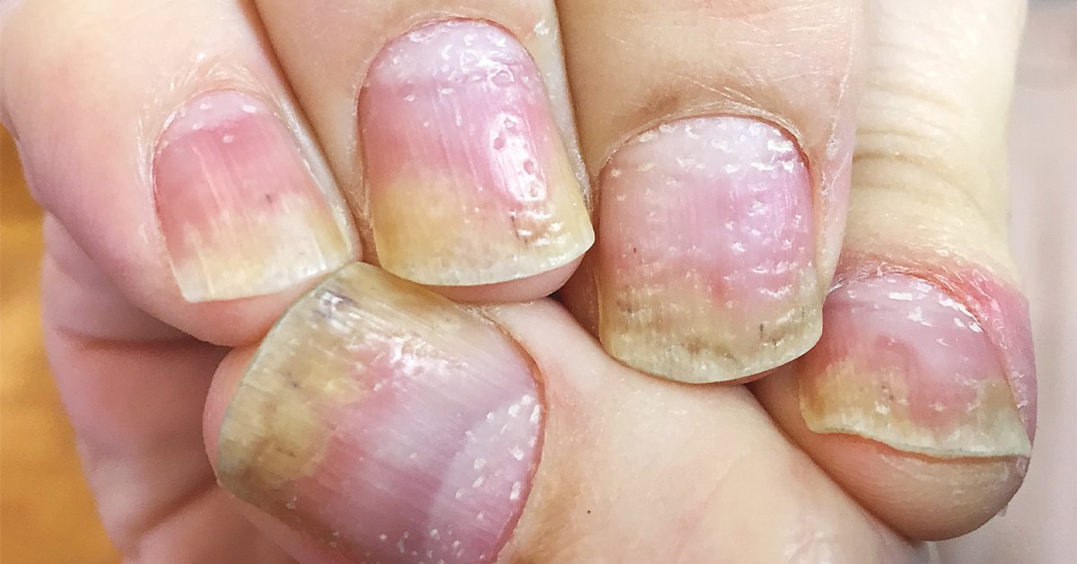 Nail pitting: How Can It Be Recognized And Treated?