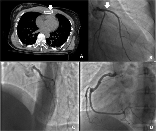 Massive #myocardialinfarction due to the #completeocclusion of the #leftanteriordescending #coronaryartery after #bluntchesttrauma by Marco Zuin, Gianluca Rigatelli, Luisella Fogato, @bepfag et al. in the October/November issue bit.ly/2L3hbjZ