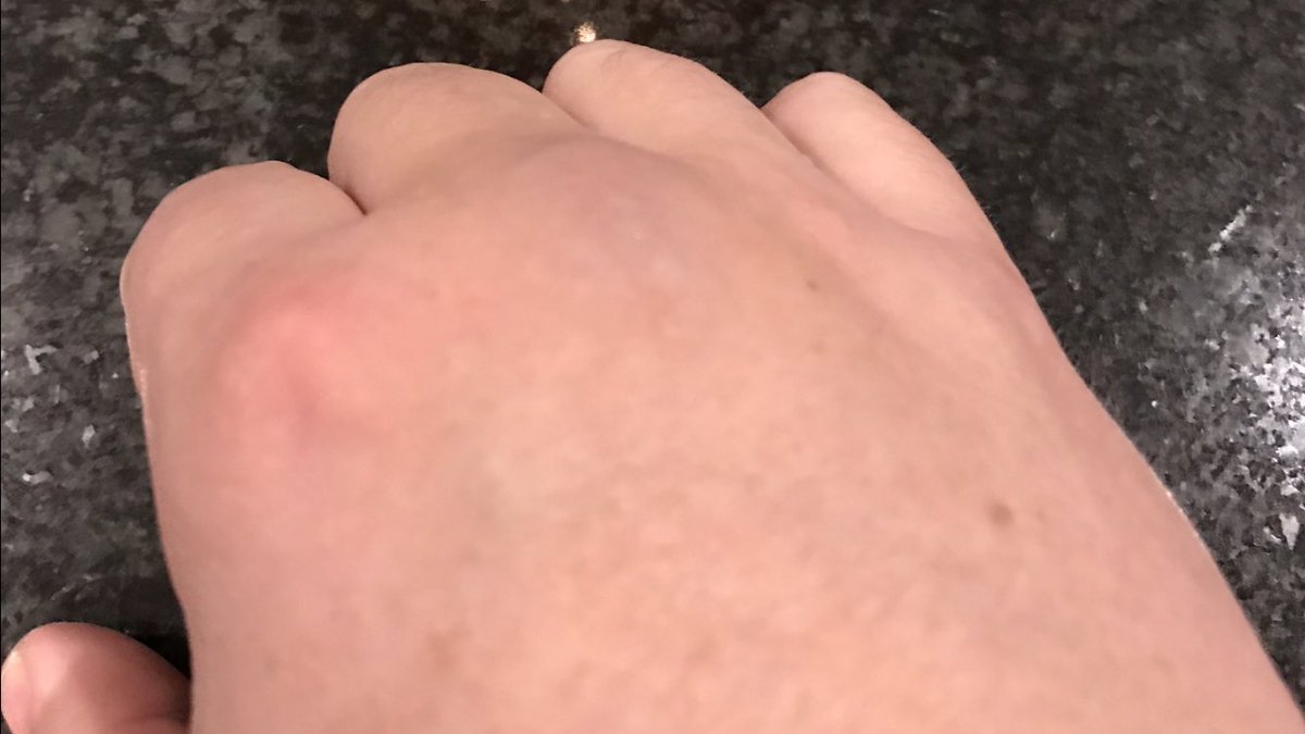 Kvällen smärtsamma lärdom. Ge aldrig priset som matchens lirare till en övertaggad 110 kilos dansk handbollsspelare. #fistbump #undraomnågoärbrutet #jeppe