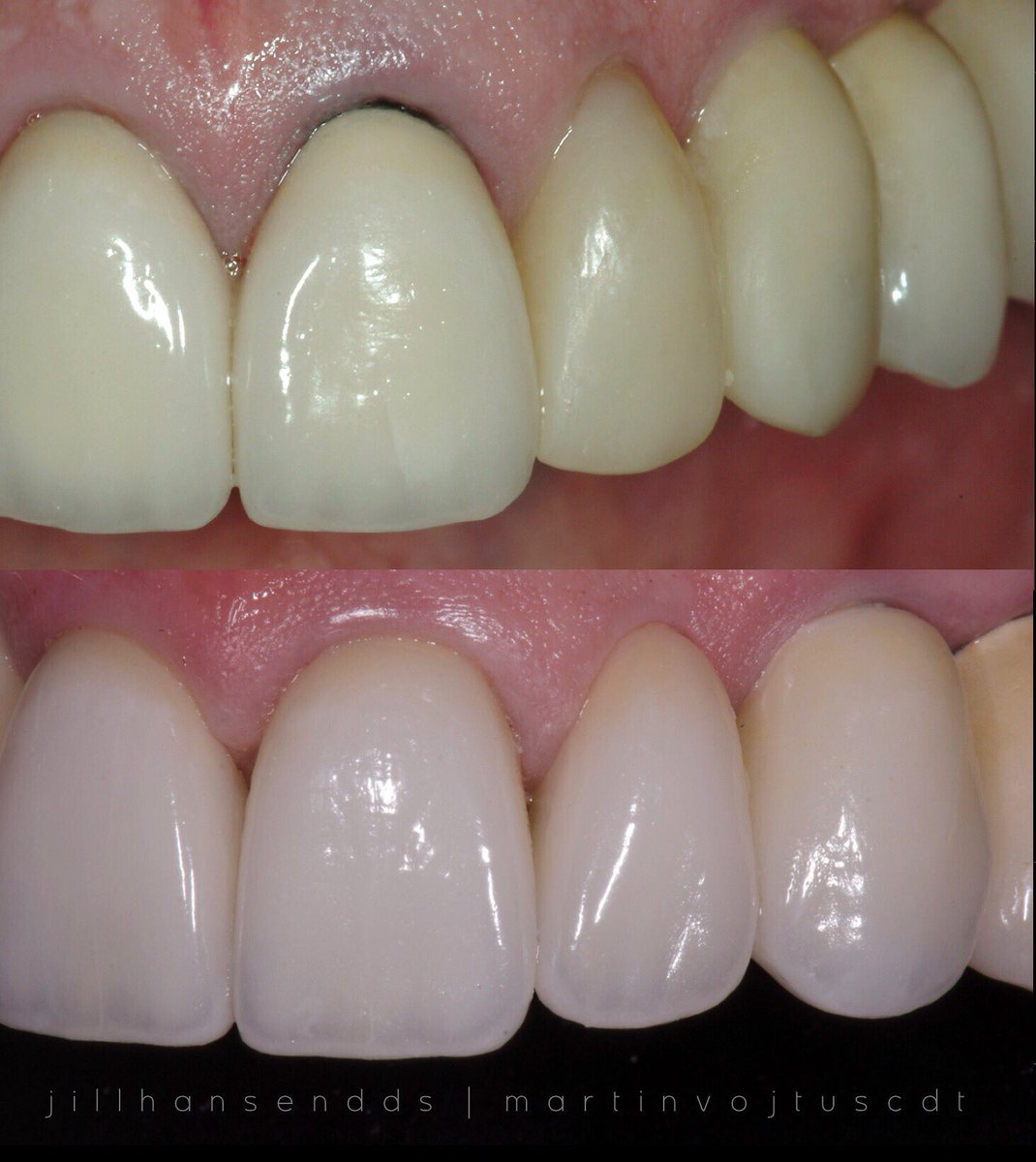 jillekinzerdds's tweet photo. There is nothing more unaesthetic than a dark line at the gum-line of a front tooth, especially if you have a big smile! Follow the link on our profile to our website and GO TO “tooth-e” and case articles to find more on this. https://t.co/LuLqu1wZFP
