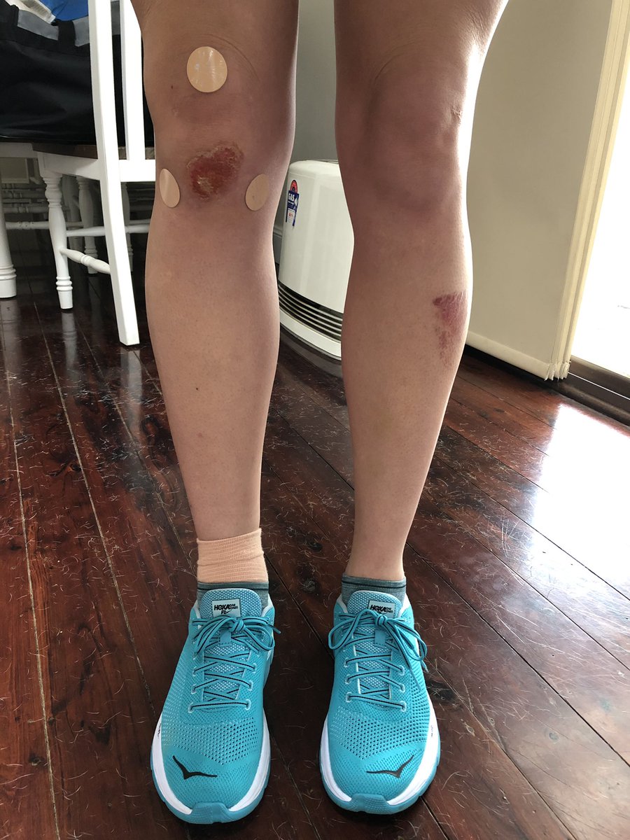 hails_trails's tweet photo. It’s official, I’m retiring from indoor volleyball #rolledankle #bungknee https://t.co/fasnsFlhEI