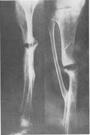En aquella época, el tratamiento de la osteomielitis crónica, sobre todo si el hueso no había consolidado, solía ser la amputación de la extremidad, o aprender a vivir con dolor crónico y echando pus por las heridas.