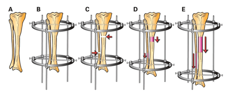 Una vez, tuvo que postponer un mes la segunda cirugía, porque se iba de vacaciones. Al volver, para su gran sorpresa, descubrió que el defecto se había llenado de hueso solo.Había (re)descubierto la distracción ósea.