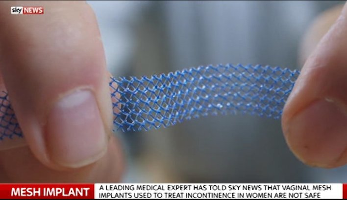 MeshCampaign's tweet photo. Surgical mesh is raised to higher risk in #Australia which means it needs stricter controls before &amp; after it goes on the market. This is planned for UK but what happens under #BREXIT ?  @carlheneghan @OwenSmith_MP https://t.co/xIz12Y2jtK https://t.co/dnaxelJZdC