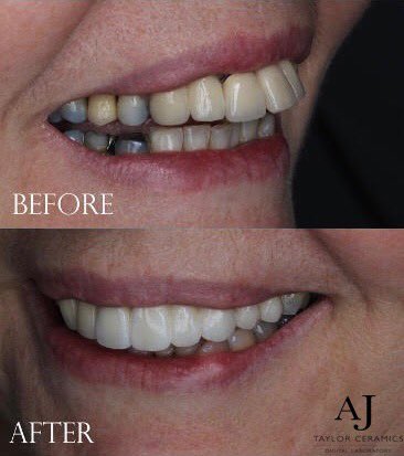 Another bit of teamwork with our dentists, by planning and going through the stages we can achieve a predictable result for patient and dentist #dentists #dental #dentallab #dentaltech #DentalTechnology #digitaldentistry