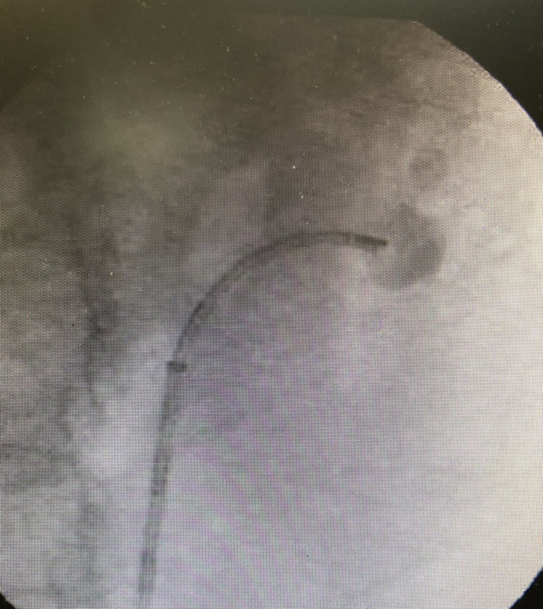 carlosh_matos's tweet photo. #supineposition #ECIRS staghorn stone + 1 stone in superior calyx with infundibular stenosis treated in 2 steps. @leogomeslopes @mateusurologia  #Endourology #semper @OTRAXER @VicentiniUro @sbinhamrii @GuidoGiusti @dadakarta https://t.co/TCGbSxRBgL