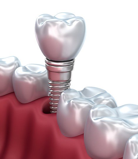 SolFamDentistry's tweet photo. Get Dental Implants from your local family Dentist #SolomonFamilyDentistry https://t.co/EnmkF1dmly https://t.co/YWEvYULdNE