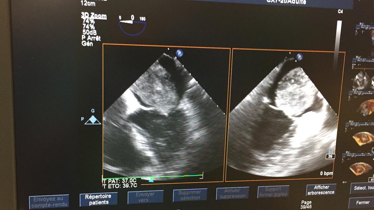 jcldib's tweet photo. ⁦@SABOURETCardio⁩  ⁦@OlivierHoffman⁩ ⁦⁦@CNCFCardio⁩ 
Urgence du dimanche https://t.co/jcCQPKEfDF