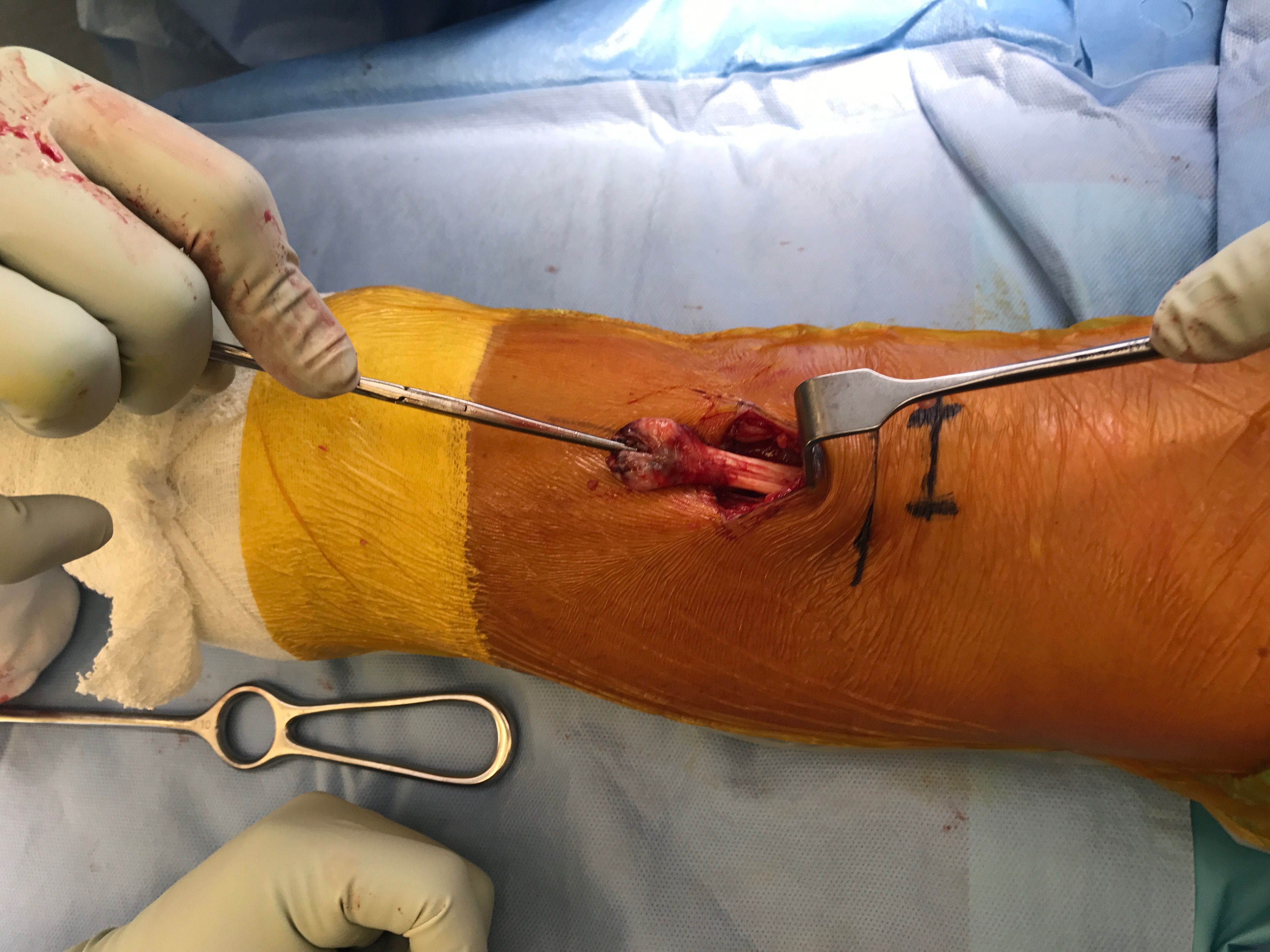 The bra strap incision in the open Latarjet procedure, Journal of  Orthopaedic Surgery and Research