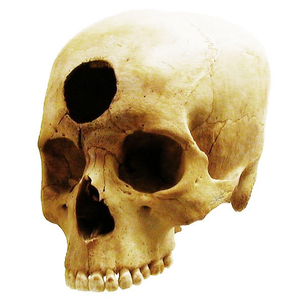 Brandon29855427's tweet photo. #WildCardTweet  #ENGL380 
Trepanning was a fairly common procedure that was done in the Middle Ages. I am kind of shocked at some of the procedures 😂 https://t.co/F5zIXRw6ws