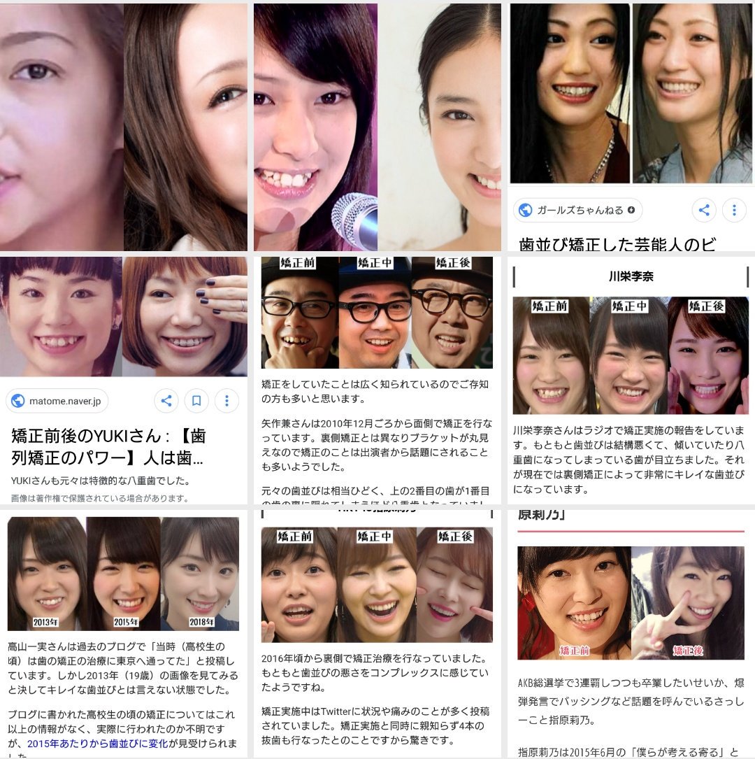 よなかちゃん 保存している 芸能人の矯正ビフォーアフター 画像を見て心を落ち着かせている