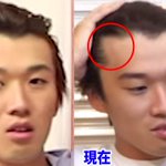 24歳でもM字後退ってこんなにするものだったのねw通院頑張れw