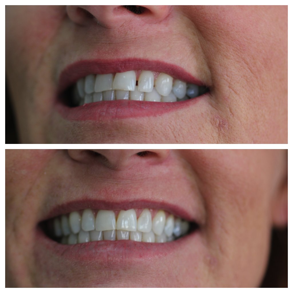 CocoonaClinic's tweet photo. Composite build up of lateral by Dr. Ashee!

#cocoonaclinic #drashee #implantologist #compositebuildup #dentist #dental #teeth #hollywoodsmile https://t.co/gUF1vK0SVf