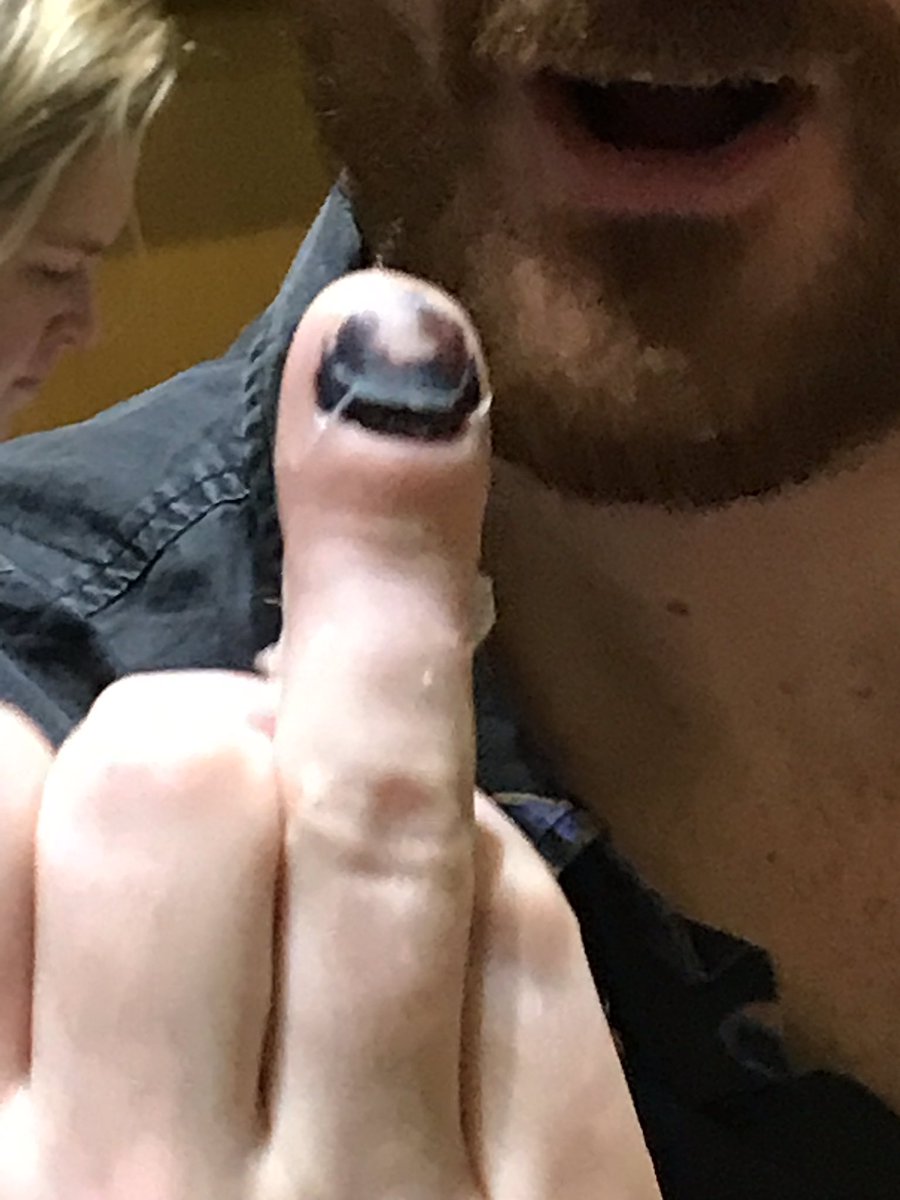 Ainsco’s messes up broken finger tip! Still played and still scored! #aveitson #propernortherner