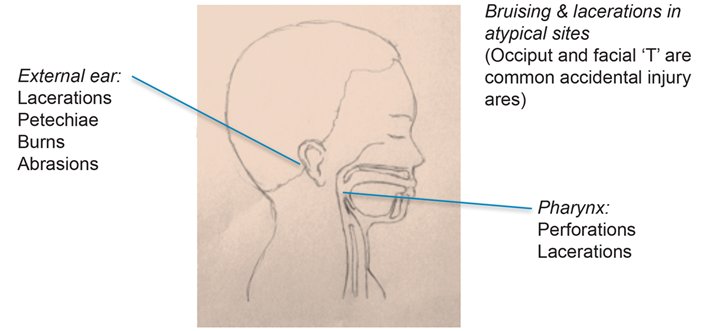 ENT_AudsNews's tweet image. Kate Stephenson explains the approach to a child who has suffered ENT trauma and provides help on what to look out for in children. entandaudiologynews.com/features/ent-f… 

#paediatrics #paediatricENT #ENTSurgery #ENTAuds