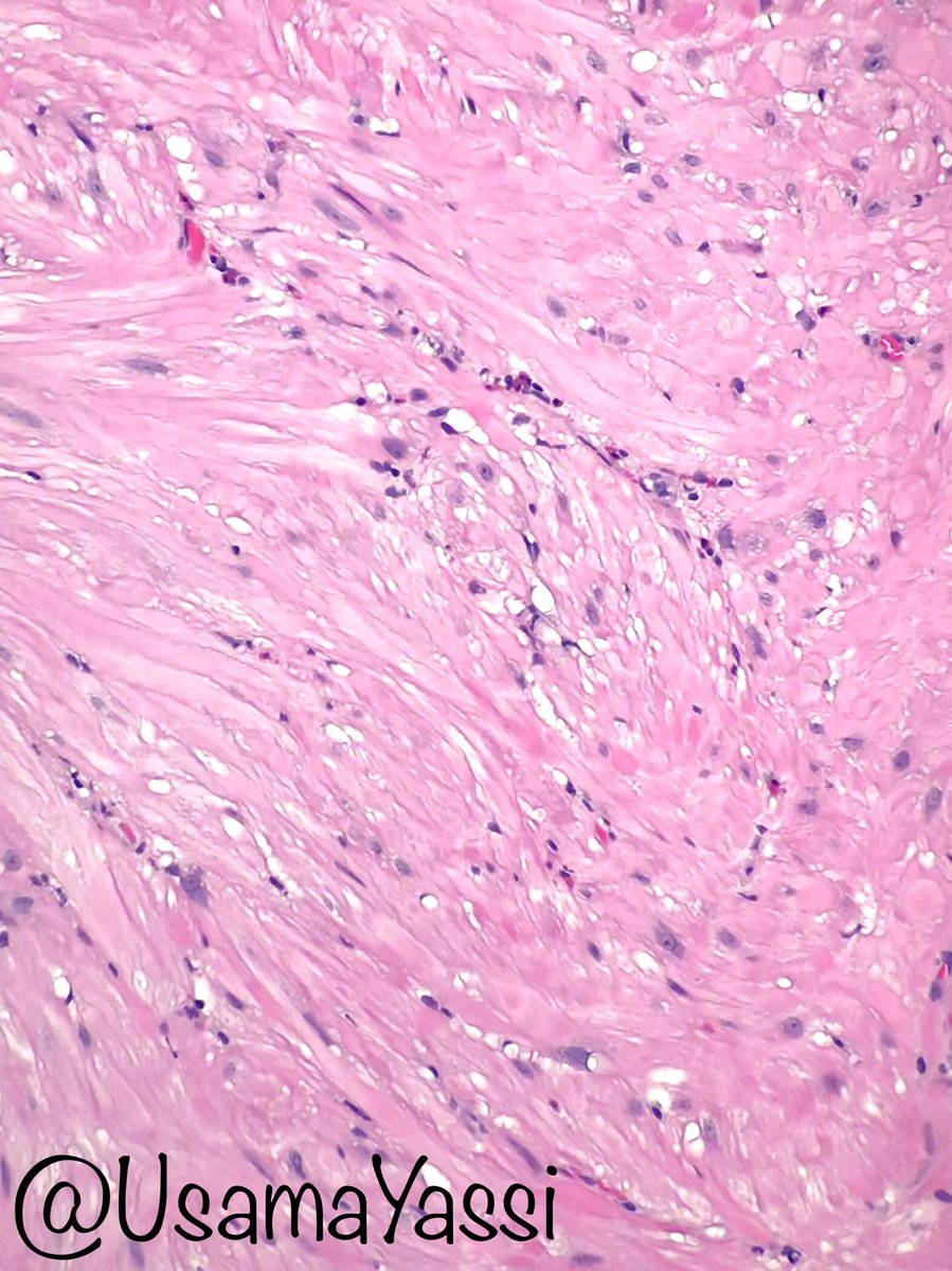 An incidental well-circumscribed 2 cm mass in the bladder wall. Low power the mass is composed of a well demarcated spindle cell neoplasm. Higher power reveals mild atypia &amp; perinuclear vacuoles. No mitosis or necrosis. Positive for desmin and SMA. Dx: leiomyoma #GUpath