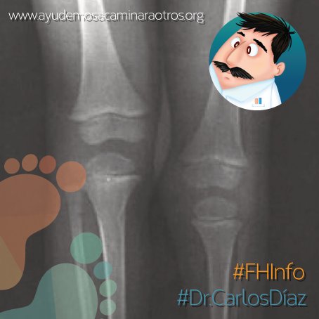FHayudaacamina's tweet photo. #FHInfo La Hemimelia peronea es un defecto de los huesos largos que cursa con un amplio espectro de manifestaciones clínicas, que van desde una hipoplasia leve de peroné hasta la ausencia total del mismo #DrCarlosDiaz https://t.co/MfKuytkR13