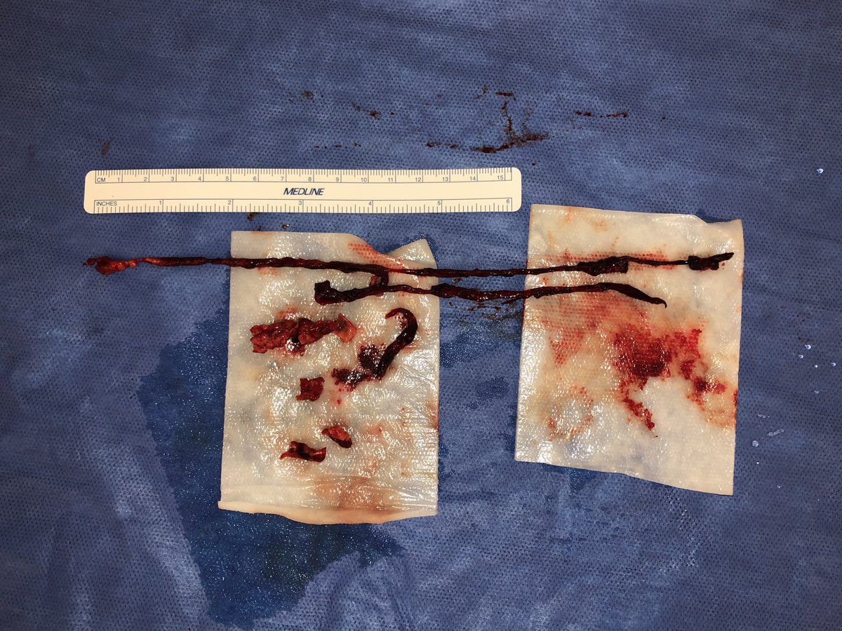 Well done, a-fib. Always satisfying plucking these suckers out. CFA/PFA/SFA thromboembolectomy.