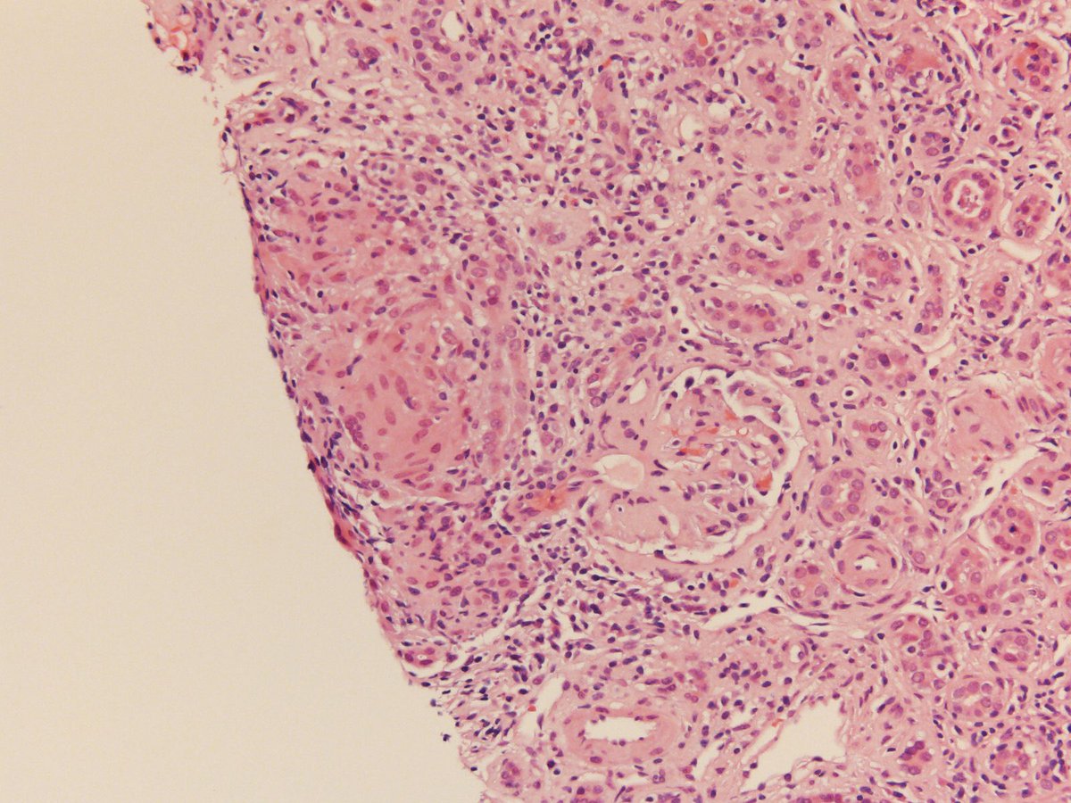 48 yo AA woman with history of RA and neurosarcoidosis yrs ago with 1 yr of fatigue, anorexia, weight loss. On admit, severe macrocytic anemia Hgb 4.3, Cr 11.8 up from 0.9 a year earlier, calcium 8.6, small kidneys on US, UA bland, trace proteinuria. A kidney bx was performed.