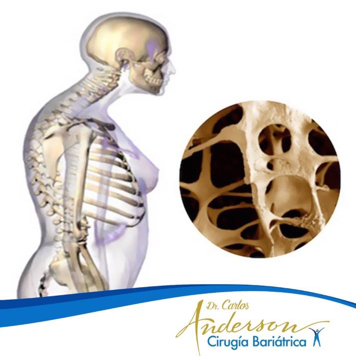 SurgeryAnderson's tweet image. La osteoporosis hace que la estructura de los #huesos se vaya debilitando, se vuelvan frágiles y porosos por la pérdida de #calcio. Estudios recientes muestran que la #obesidad es una causa importante de #osteoporosis tanto en hombres como en mujeres. #DrCarlosAnderson