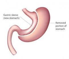 ClinExpPathol's tweet image. Clinical Effectiveness of Routine Pathological Exam after Bariatric
#Laparoscopic Sleeve #Gastrectomy
bit.ly/2QwTvHj