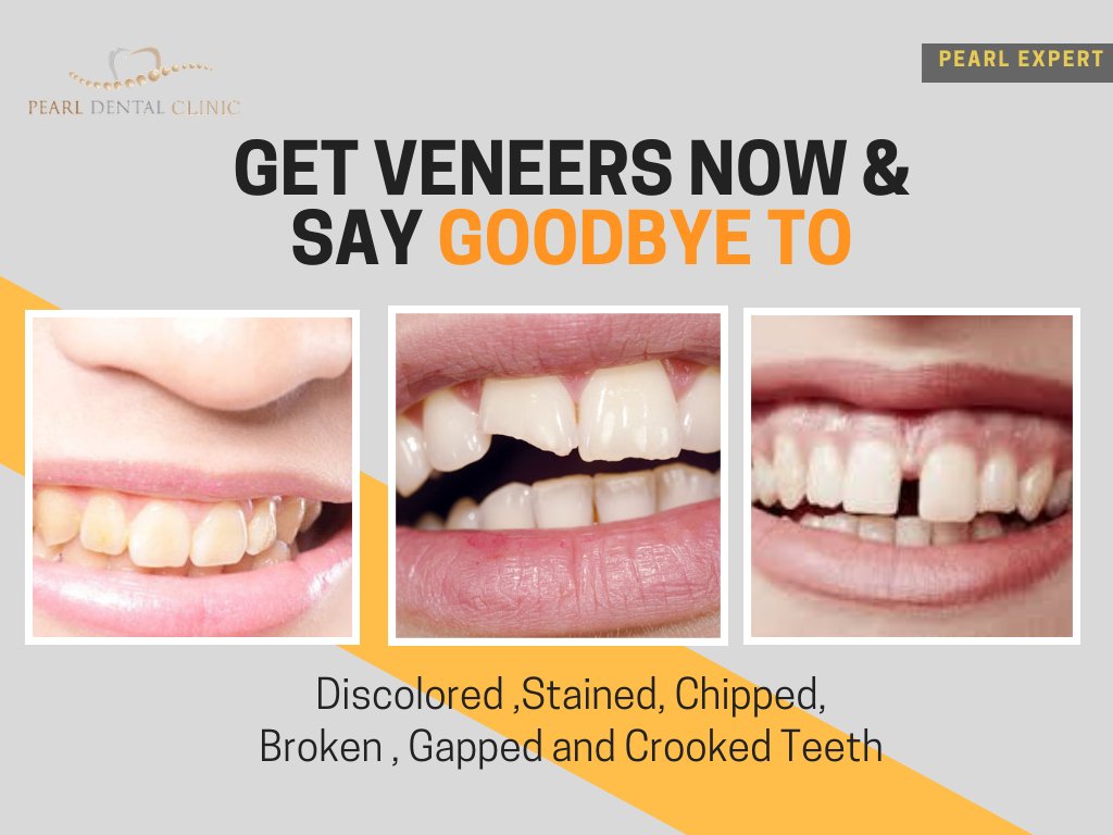 pearldentaldxb's tweet photo. Have you been hiding your smiles for years due to discolored, cracked or chipped teeth ??
#DentalVeneers #Veneers #TeethWhitening #HollywoodSmile #AsktheExpert #PearlDentalClinic #DentistDubai #BestDentalClinic #FriendlyDentist #businessBay #WaterCanal #BurjKhalifa #DubaiDental https://t.co/lWsevWDh3b