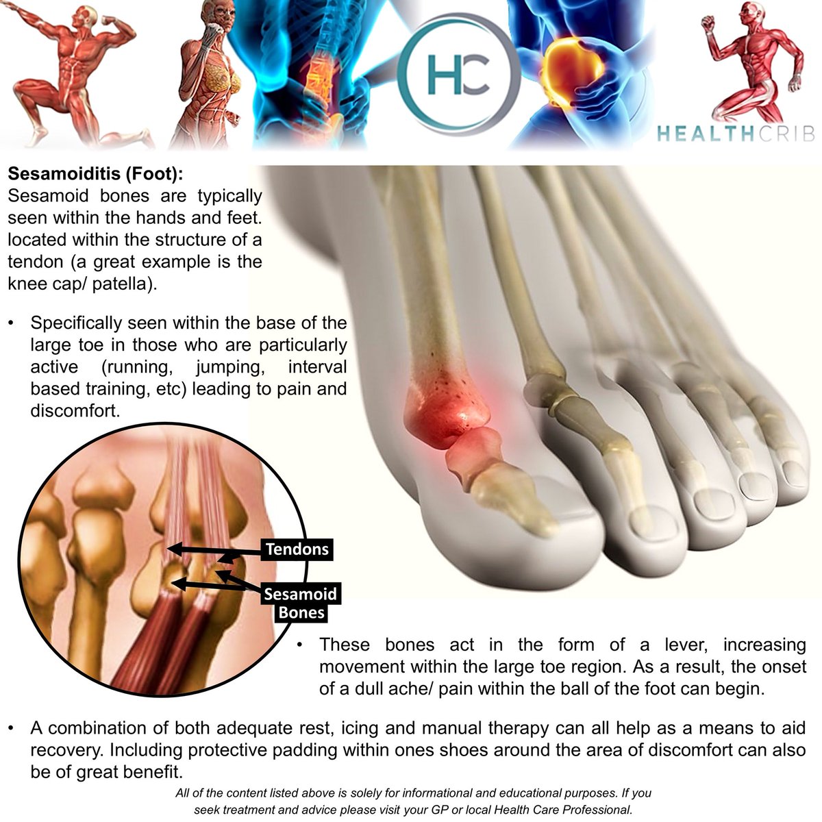 Healthcrib_fdt's tweet photo. THE FOOT: Sesamoiditis of the foot (big toe) can have a number of signs and symptoms typically brought on by activity levels. #alignment #footsurgery #footinjury #footpain #footstrength #footsprains #footwear #footrecovery #footexercise #footmechanics #sesamoiditis #sesamoid https://t.co/TZGw5HXdjQ