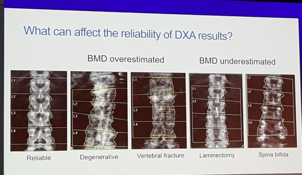 nxtstop1's tweet photo. ▶️#Osteo2018 @OsteoporosisSoc @OsteoporosisHCP

Next UP: Alison Doyle

Dr Nicola Peel discusses DXA reporting – #BoneScans

-Pitfalls of interpretation #DXA
-What reports should contain
-Use ALL available information to provide context

h/t  @OsteoRadJill, @AlisonD1971 @cehigham https://t.co/R2Mr3dazVI