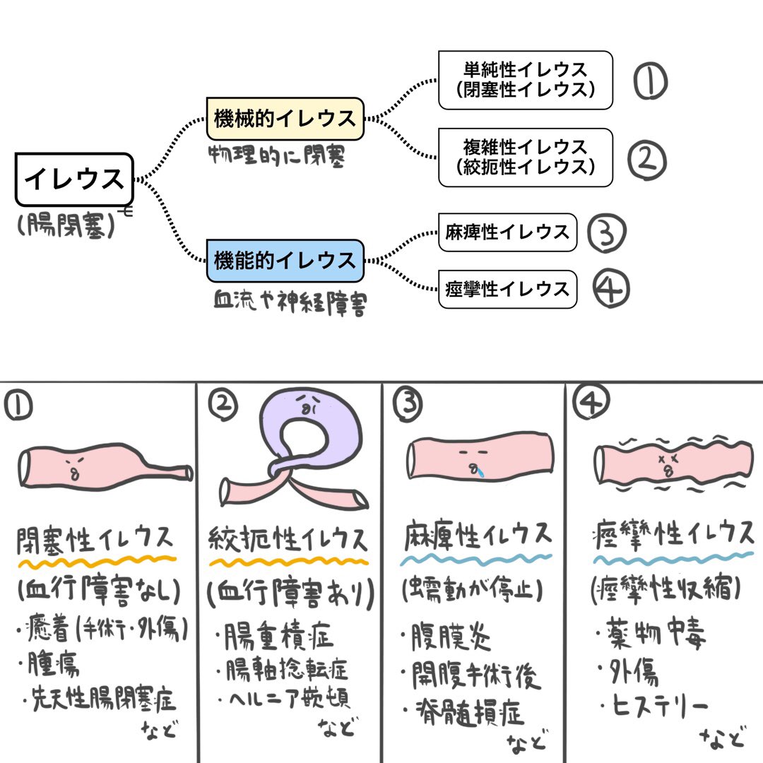 Twitter पर ゴロ 解剖生理イラスト イラストで分かる イレウス 腸閉塞 の種類と原因まとめ