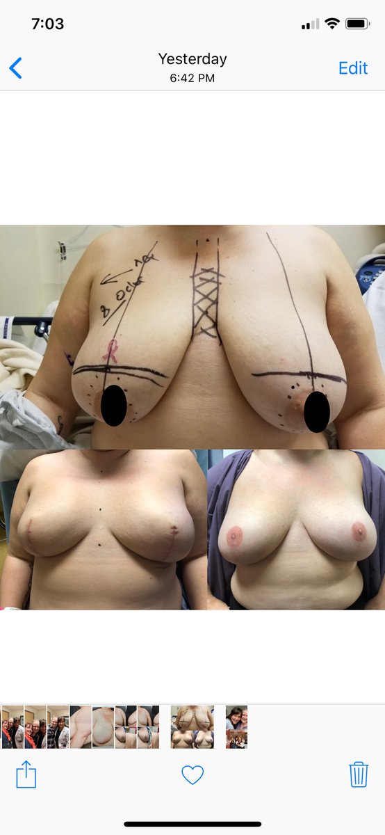 tstormmd's tweet photo. What we can accomplish for our patients when we work as a team (breast surgeon, plastic surgeon, medical and radiation oncology and the PATIENT). Before and after skin sparing mastectomies with prepectoral reconstruction and 3D tattoo. #breastsurgery #breastcancertreatment #mammo https://t.co/fRZEEmlKyK