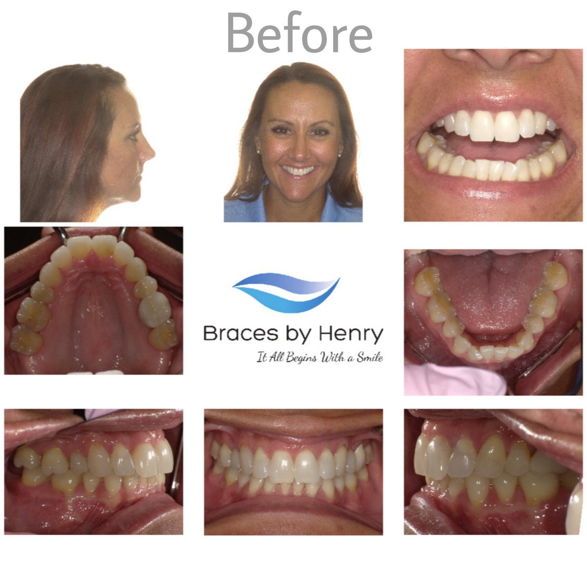 Uzivatel Braces By Henry Na Twitteru Before After Braces Patient Katherine G Case Details Katherine Had Upper And Lower Braces Treatment The Upper Braces Were Clear Ceramic Brackets Not As