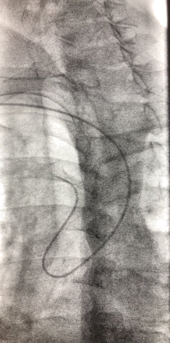 matheenkhuddus's tweet image. Been #RadialFirst for all carotid angiography and many CAS cases for sometime now....was only a matter of time until the lusoria was going to show up! #SCAIPAD