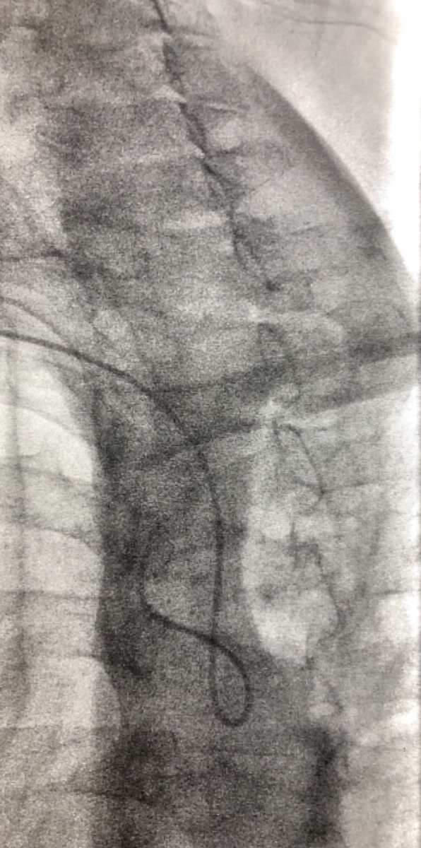 matheenkhuddus's tweet image. Been #RadialFirst for all carotid angiography and many CAS cases for sometime now....was only a matter of time until the lusoria was going to show up! #SCAIPAD