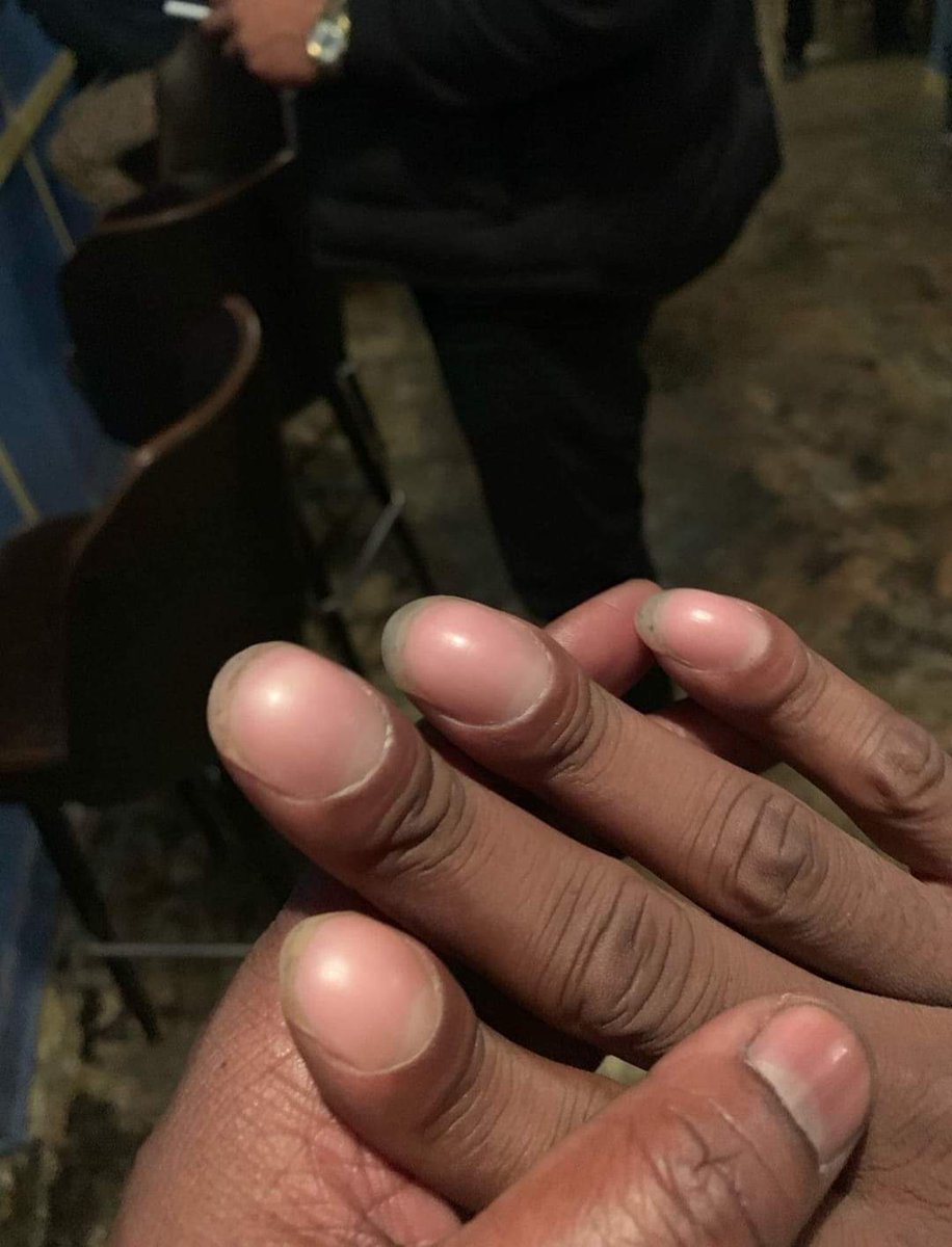 LoveMarlieB's tweet image. Nightmare #ScaryHour hands RT @JappOffJones: Stay away from me if you got these 🙅🏽‍♂️