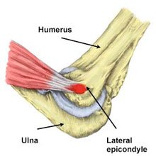 vsicltd's tweet photo. Most causes of tennis elbow are nothing to do with Tennis. Gripping heavy objects or overuse of a manual screwdriver is likely to be the cause for most people. Treat yourself to a power screwdriver!! https://t.co/B4bX6R1k3A #tenniselbow #sportsinjuries https://t.co/lfnyLOmNxQ