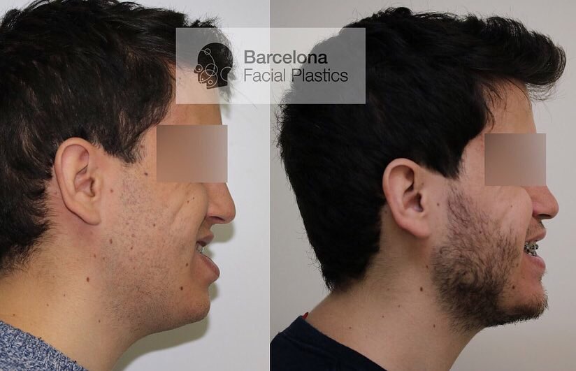 Barcelona Facial Plastics tweet media