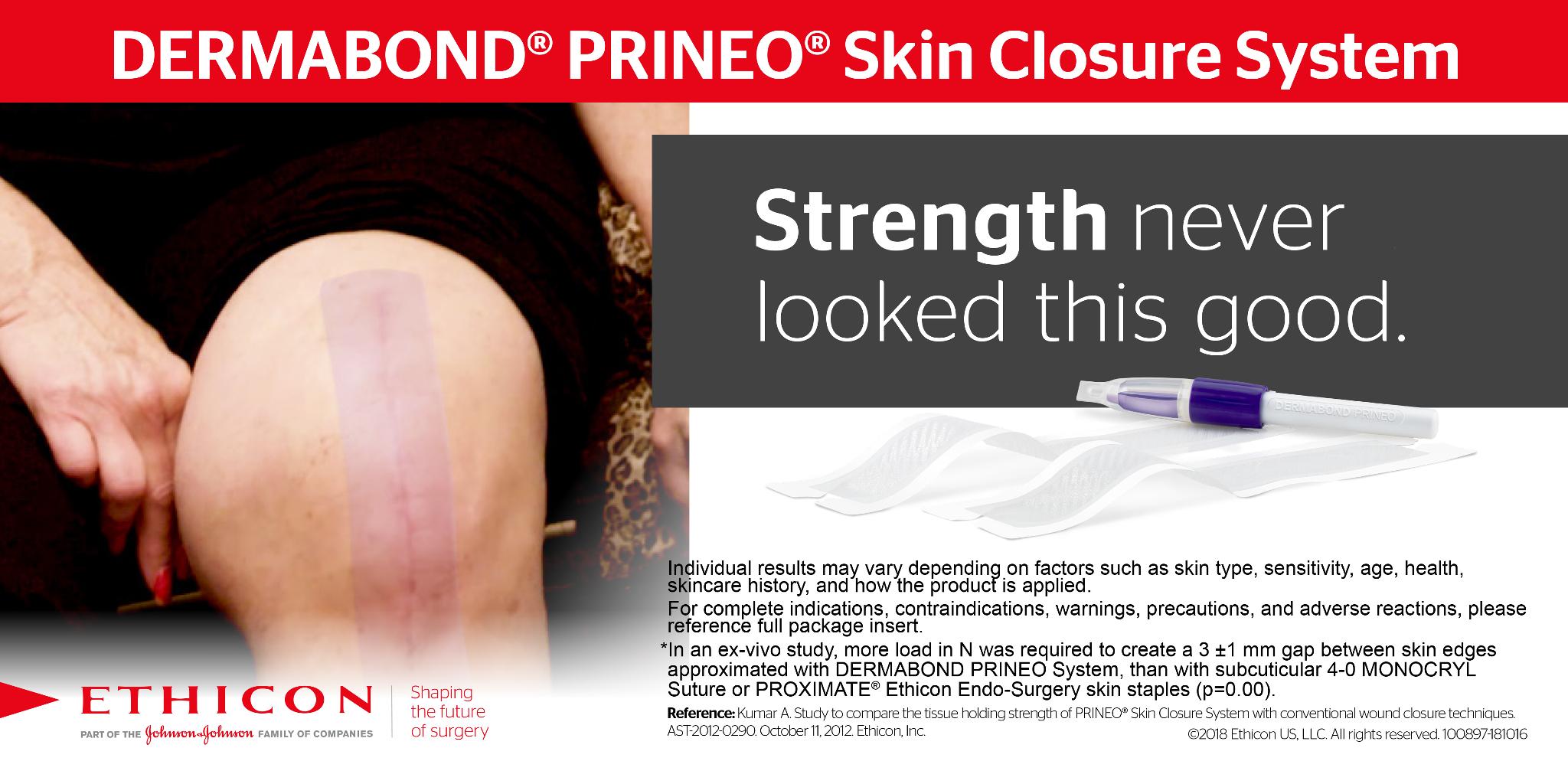 Ethicon on X: DERMABOND® PRINEO® Skin Closure System was shown to provide  statistically significant greater skin holding strength than skin staples  or subcuticular suture.* Click here for more information   #DERMABOND #PRINEO #