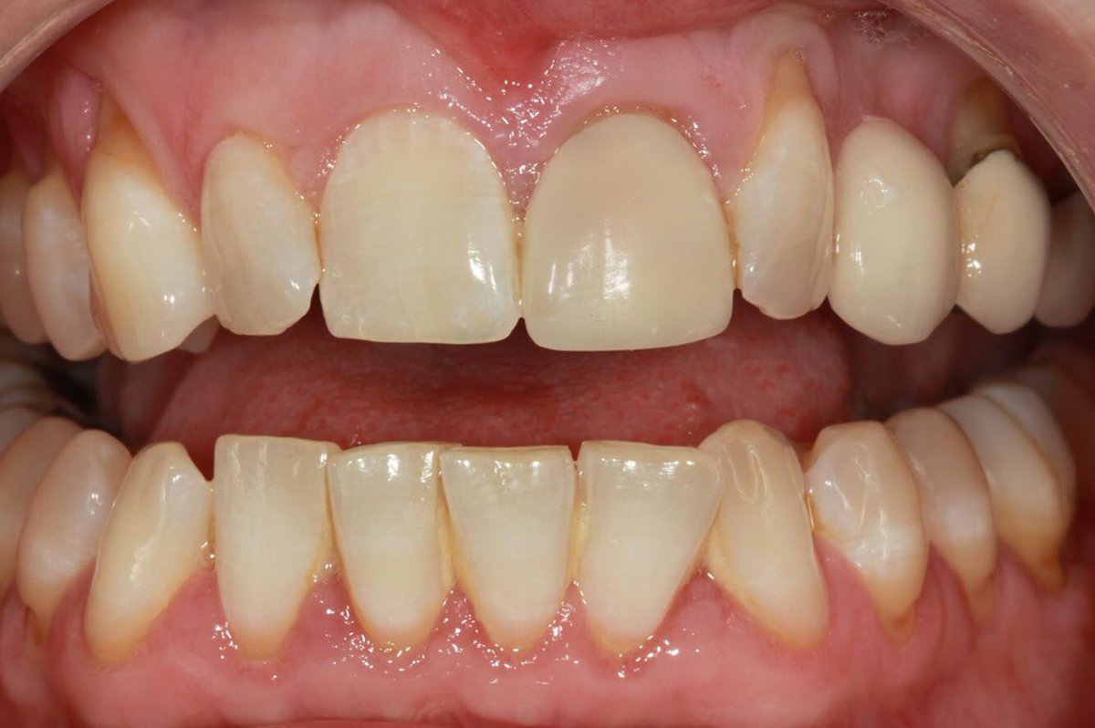 Matching a central is one of the most challenging aspects of dental technology. Using the eLab shade matching protocol and custom dentine recipe we can digitally try the crown in before it is sent out of the lab. Also helps having a enough room for porcelain