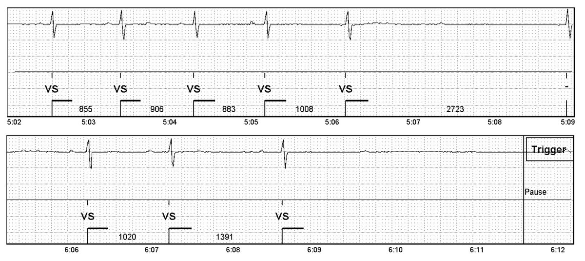 GabrielleCumps1's tweet photo. Humbling for our #ConfirmRx ICM to have been honored by Time and Popular Science but even more rewarding is impacting this patient’s life. Syncope Explained!  #ProudToBeAbbott https://t.co/2YwjE5lnMk