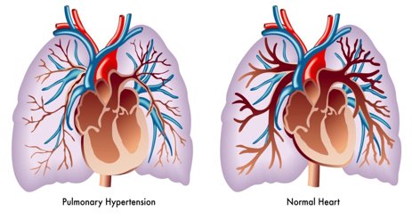 CRMjournal's tweet photo. #PredictiveValue of #Baseline #PulmonaryHypertension in Early and #LongTerm #Cardiac and #AllCauseMortality after #TAVI for #Patients with Severe #AorticValve #Stenosis by @dami13, ... @ekoikonomou, ... @ehrin_armstrong, ... @GGiannakoulas in Oct/Nov issue https://t.co/Pn7B9o0kAS https://t.co/a9TZyyDkDn