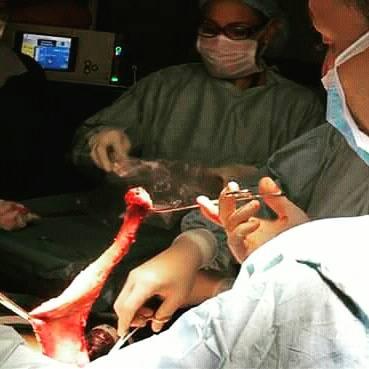 SurgeryAnderson's tweet image. En esta cirugía se extirpó una porción del estómago, reduciendo su capacidad. #DrCarlosAnderson #CirugiaBariatrica #CMDLT