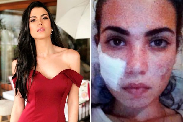 dailystar's tweet photo. ‘It ruined my face’ Miss Universe star reveals how botched surgery nearly ended career #MissUniverse #MissUniverse2018 #MissChile #AndreaDiaz https://t.co/f37lw0gjBg https://t.co/ufp5AZbiQM