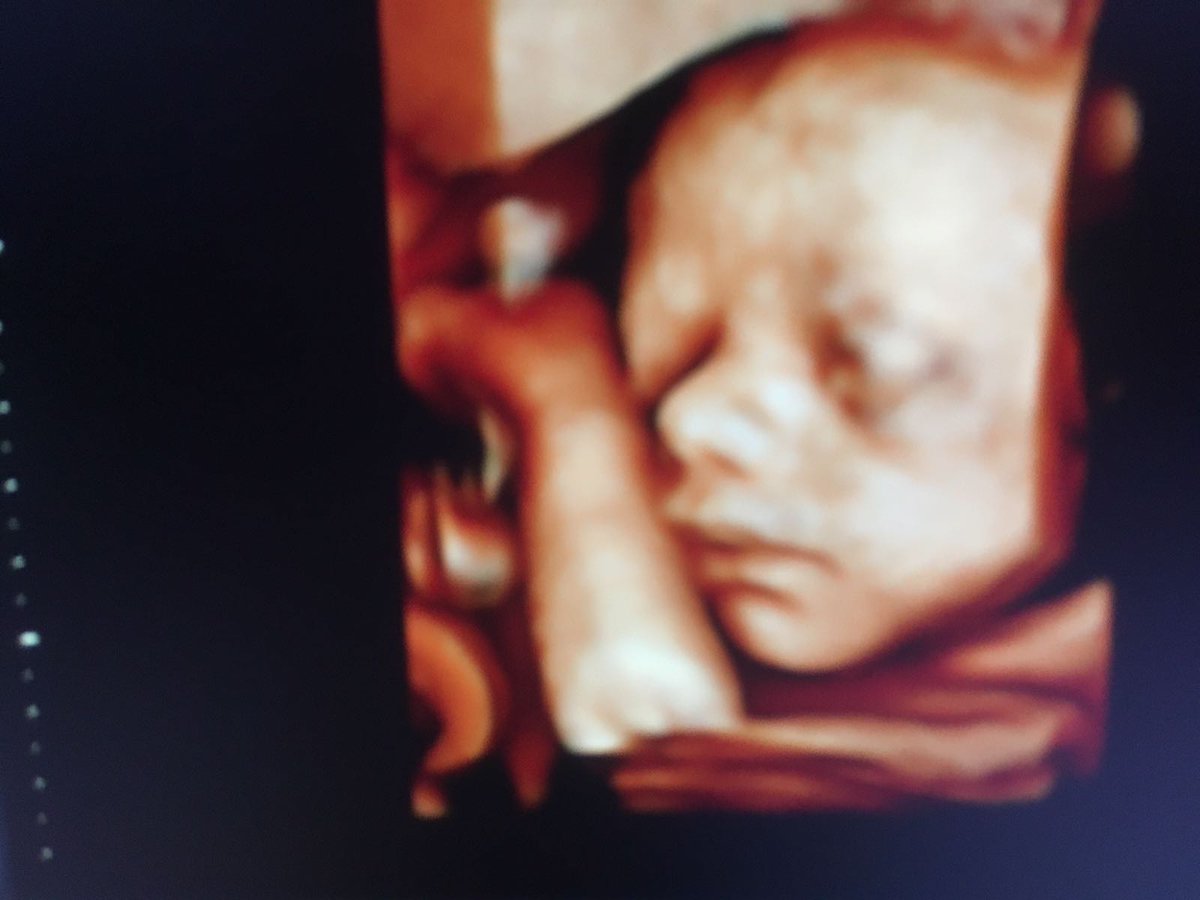 fetal_uk's tweet image. I love it when parents come along for 3D scans and get to see their little one in such detail for the first time 👶

#fetalmedicineuk #30weekspregnant #3dbabyscan #4dbabyscan #babyscan #babyscans #hellobaby #pregnant #pregnancy #baby