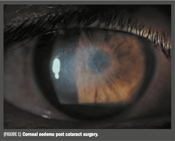 OphthTimes's tweet photo. New treatment reduces #corneal #oedema after #cataract surgery https://t.co/RzcUlCAGXW #Ophthalmology https://t.co/sVLt2mx3TG