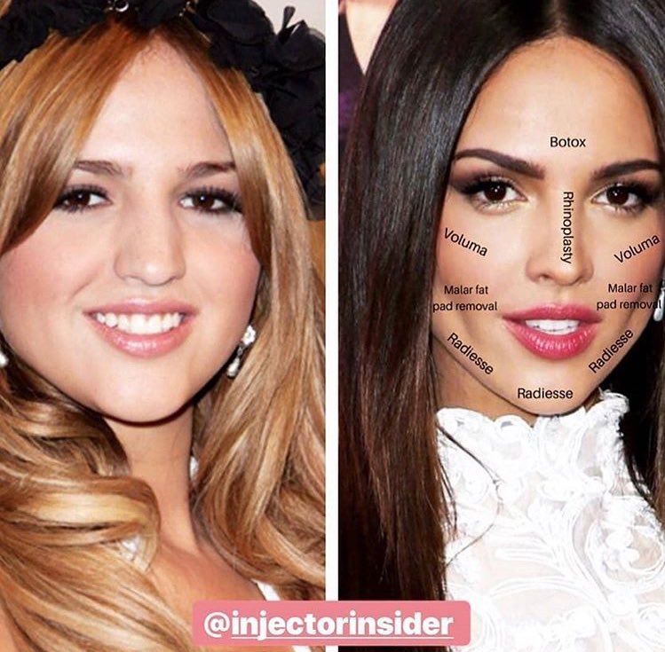 Belinda Before And After Surgery