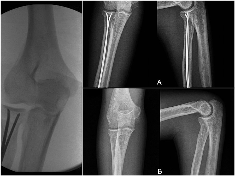 ALMATEC_SOCIAL's tweet photo. #INTRAMEDULLARY REDUCTION AND STABILIZATION TO TREAT #RADIALNECK #FRACTURES IN ADULTS
Isolated radial neck fractures are very rare and the majority can be treated conservatively. However, conservative treatment might result in malunion ...
https://t.co/xM6ZO6fMEH https://t.co/DbKDyJRO3w