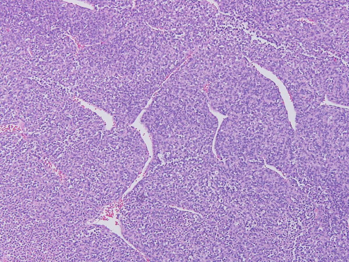 NPathRes's tweet photo. 28 Y/O M, rapidly growing flank mass. CD99 positive, EWSR1 FISH negative? What would you do next? Diagnosis? #BST #bstpath #Mayo_Path @MayoClinicPath #BST_Path https://t.co/jFDyVvbMns